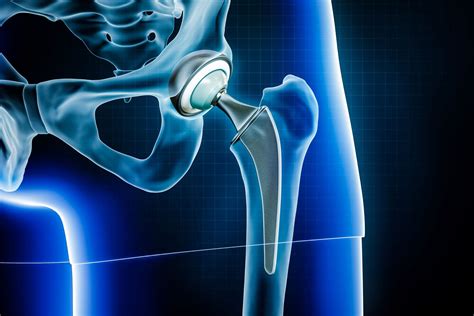 hip replacement rhode island|providence total joint.